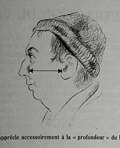 Dilatation du visage — mesure en profondeur (de la pommette à l'oreille)