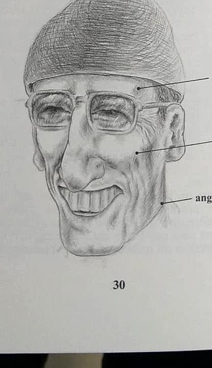 Rétraction du visage — bâti longiligne (crête temporale, pommette, angle mandibulaire)